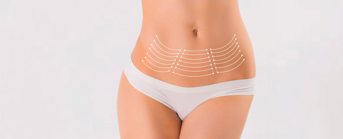 Міні-абдомінопластика