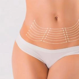 Мініабдомінопластика