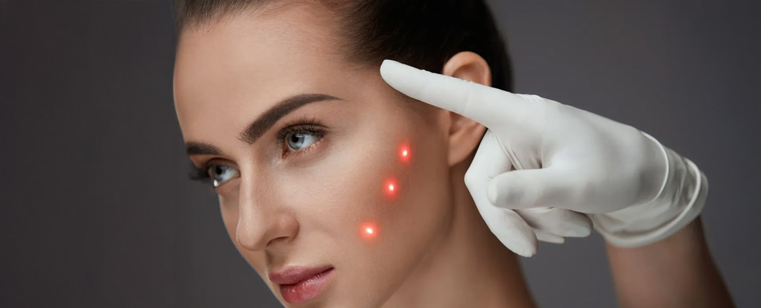 Лазерне шліфування рубців та шрамів постакне