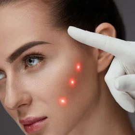 Лазерне шліфування постакне