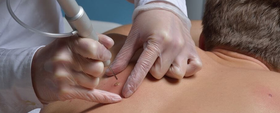 Видалення ліпоми (жировика)