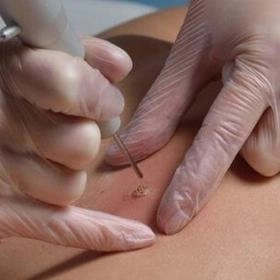 Видалення ліпоми