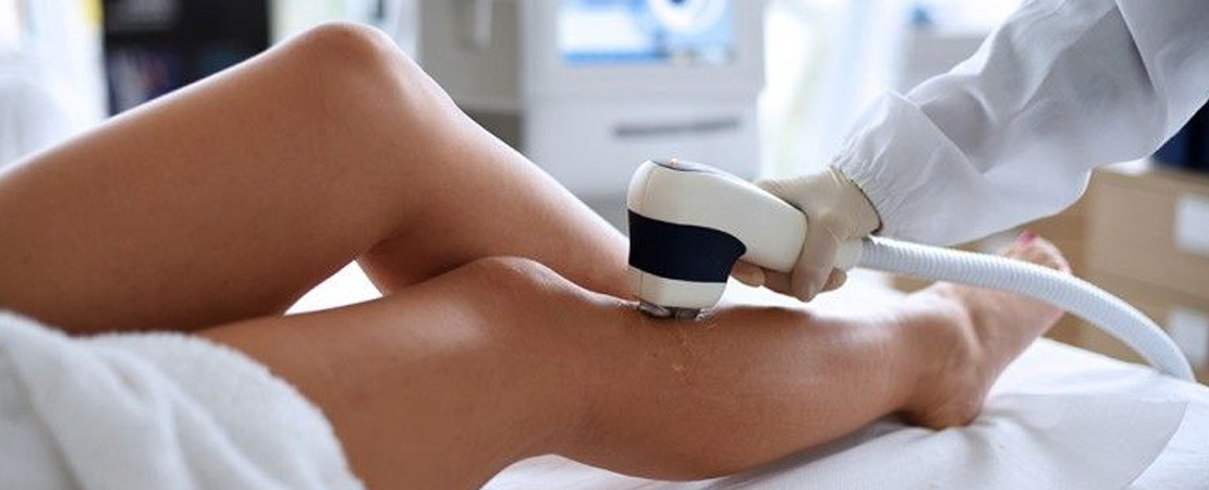 Лазерна епіляція ніг