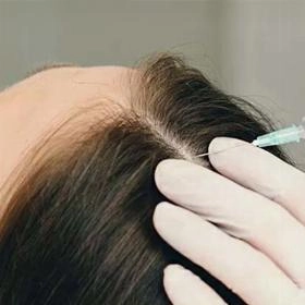 Мезотерапія голови