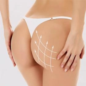 Ліпофілінг сідниць