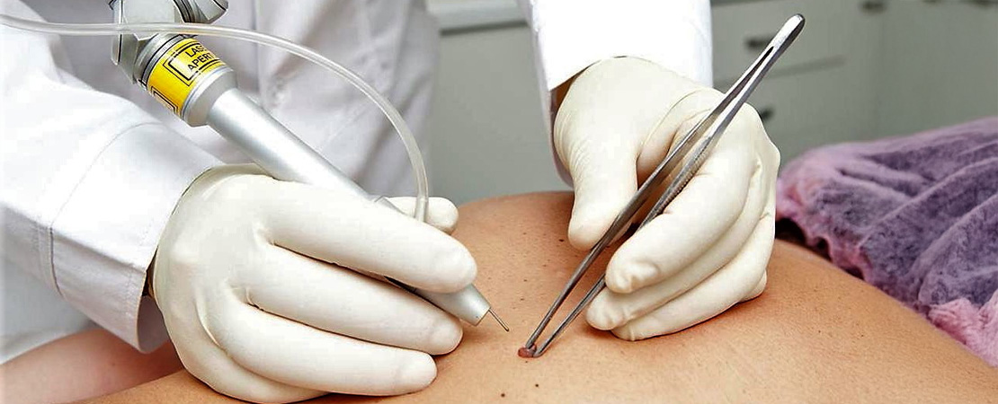 Лазерне видалення родимок