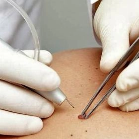 Лазерне видалення родимок