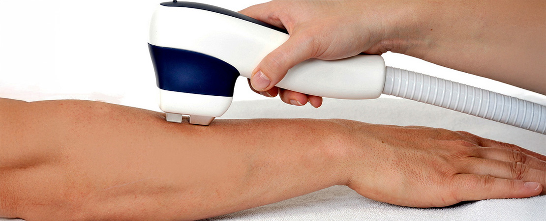 Лазерна епіляція рук