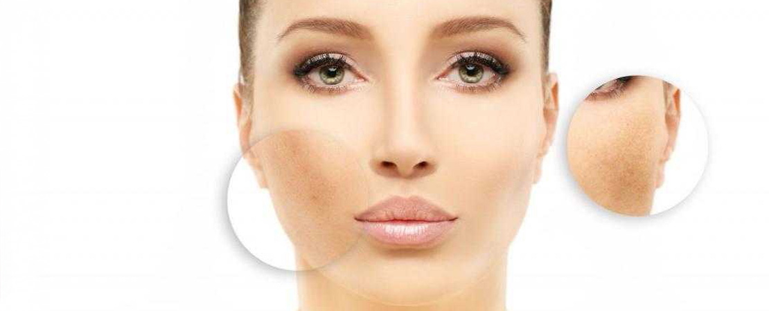 Лазерне видалення пігментних плям