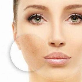 Лазерне видалення пігментації