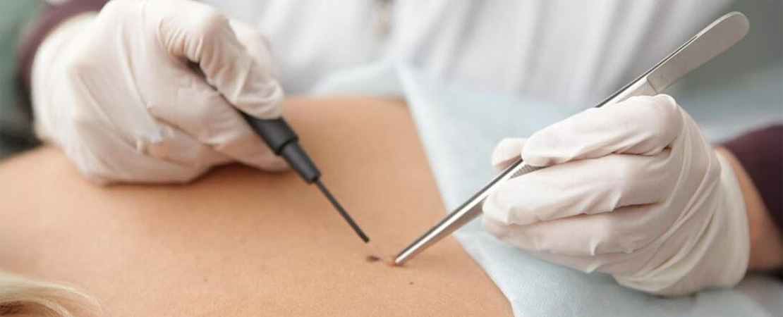 Видалення новоутворень на обличчі та тілі