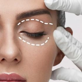 Блефаропластика