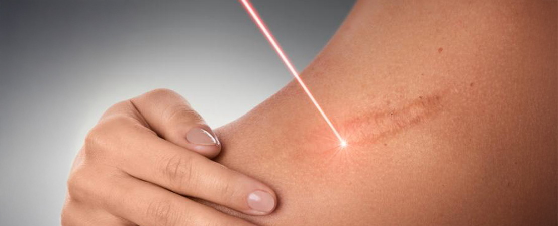 Лазерне шліфування рубця та шраму