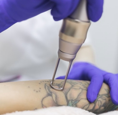 Крупний план лазерного впливу на татуювання під час процедури видалення