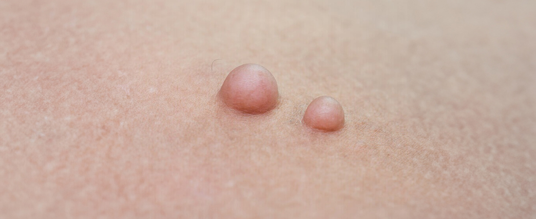 Причини утворення ліпоми