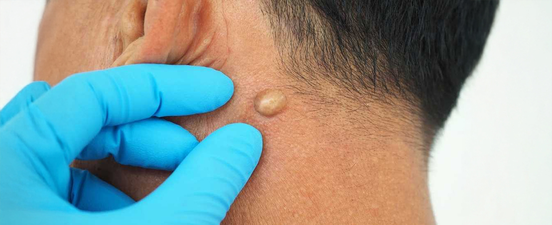 Симптоми ліпоми Симптоми ліпоми