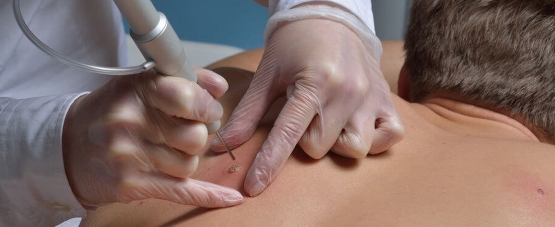 Методи лікування ліпоми Методи лікування ліпоми