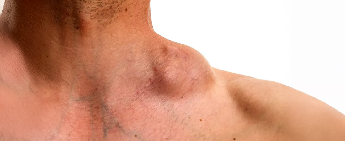 Чи може ліпома перерости в рак Чи може ліпома перерости в рак