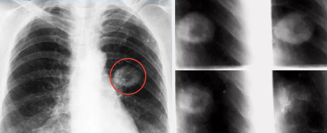 Ліпома на внутрішніх органах Ліпома на внутрішніх органах
