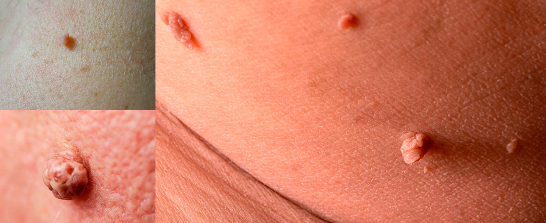 Відмінності ліпоми від інших утворень Відмінності ліпоми від інших утворень