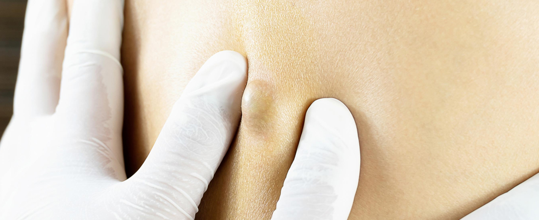 Міфи про ліпому Міфи про ліпому