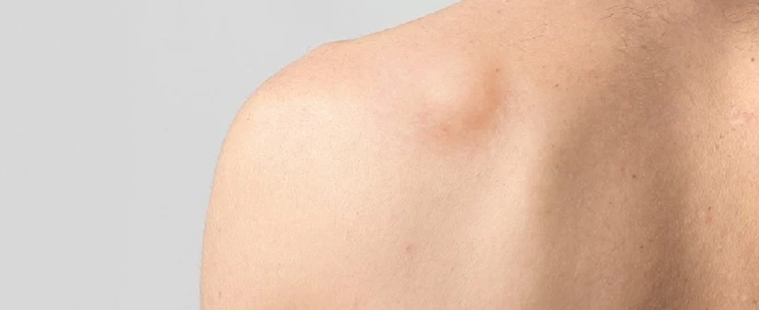 Ліпома нешкідливе новоутворення Ліпома нешкідливе новоутворення