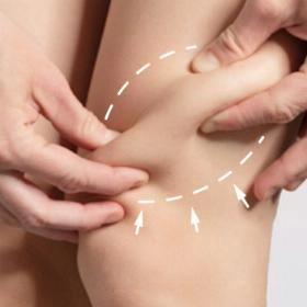 Ліпосакція колін