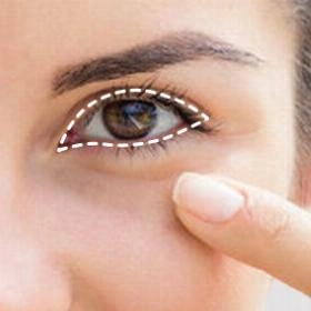 Кантопластика