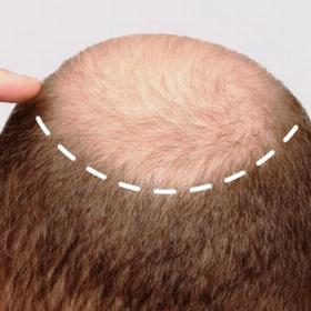 Пересадка волосся на голові до -10%