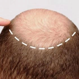 Пересадка волосся на голові