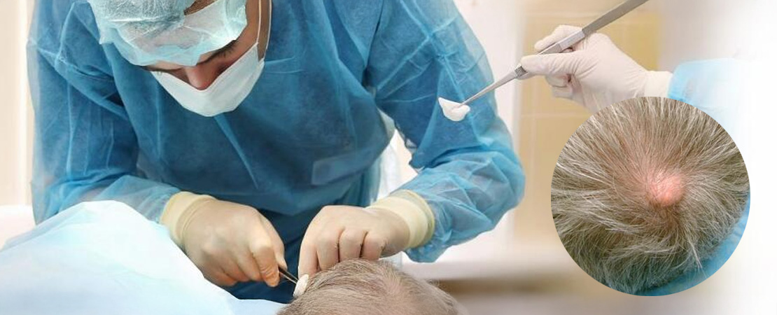 Видалення атероми