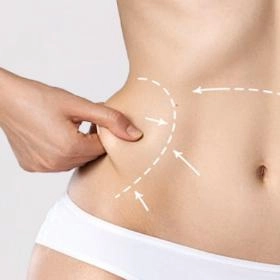 Ліпосакція боків