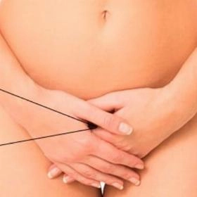 Видалення кондилом в інтимній зоні