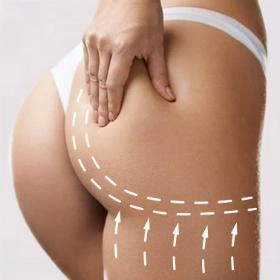 Ліпосакція сідниць