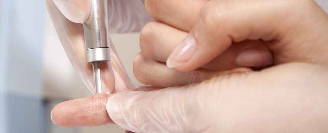 Лазерне видалення бородавок