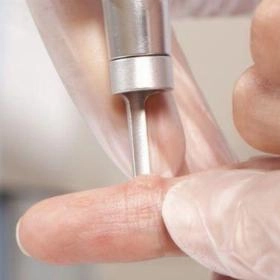 Лазерне видалення бородавок