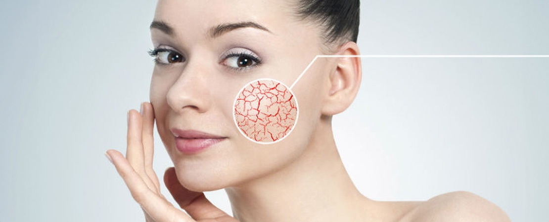 Лазерне видалення судин на обличчі та тілі