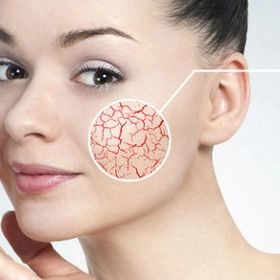 Лазерне видалення судин