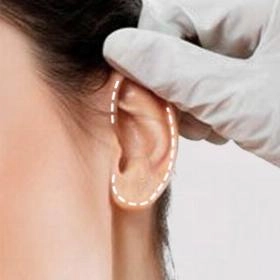 Отопластика