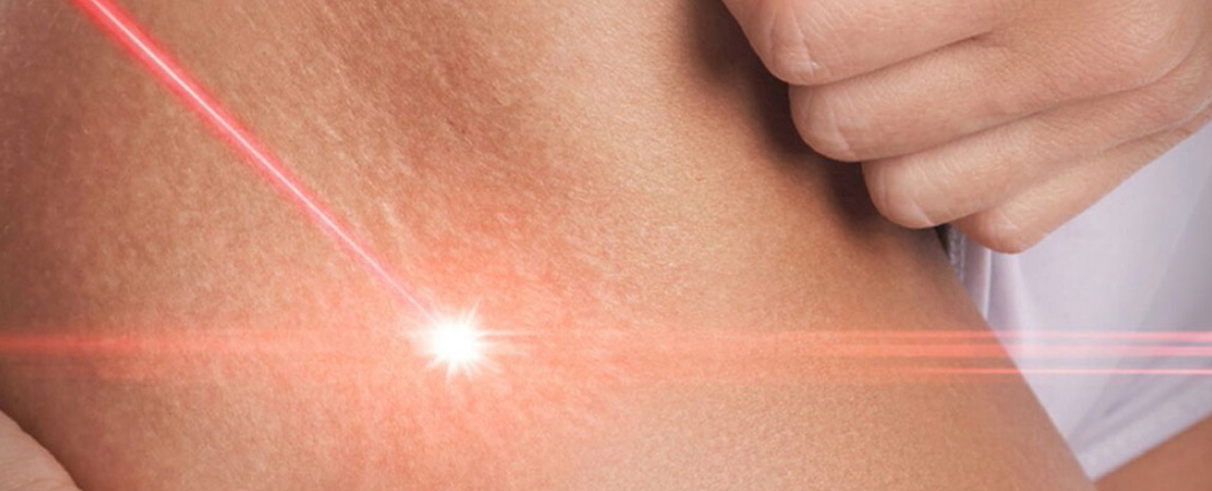 Лазерне шліфування розтяжок