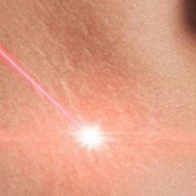 Лазерне шліфування розтяжок