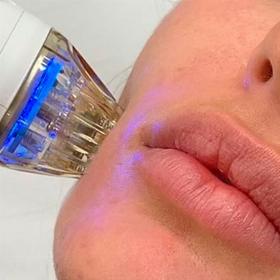 Мікроігольчастий RF ліфтинг до -25%