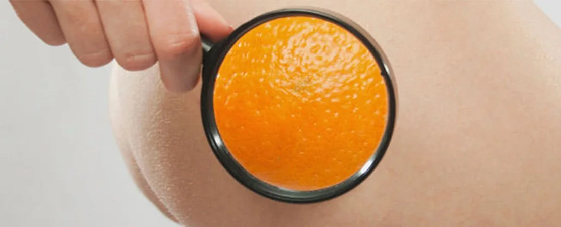 Лікування целюліту