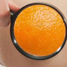 Лікування целюліту 