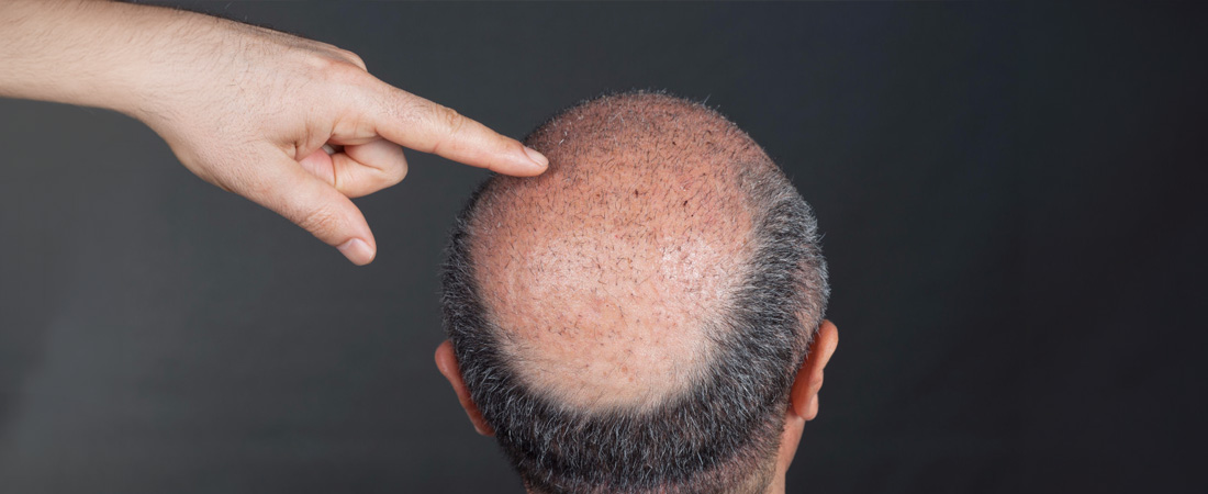 Пересадка волосся: особливості методик, реабілітація та ризики