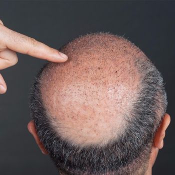 Пересадка волосся: особливості методик, реабілітація та ризики