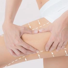 Ліпосакція стегон