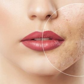 Лазерне шліфування обличчя -50%