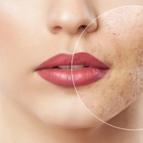 Лазерне шліфування обличчя